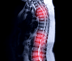  Spinal Stenosis