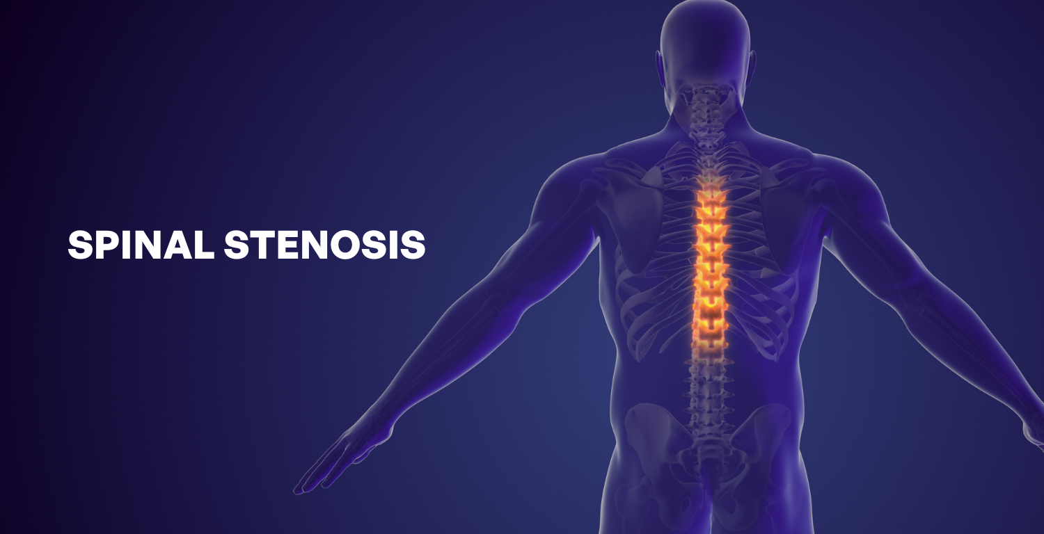 SPINAL STENOSIS: Treatment for spinal stenosis by the best physiotherapy clinic near Pari-chowk, Greater Noida – Spineact (Spine&Shoulder Clinic)